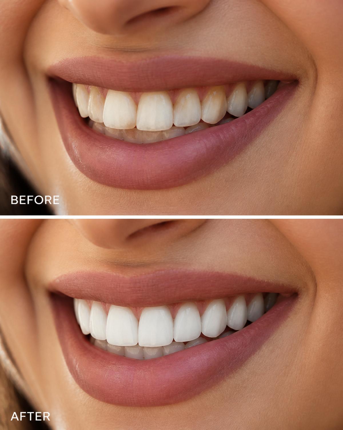 Antes & Depois